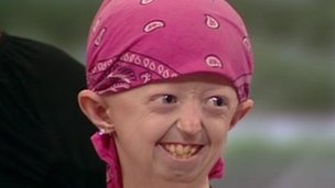 Хейли окинс. Прогерия хатчинсона-гилфорда. Хейли окинс. Хейли окинс. Детская прогерией смертность.