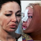 Саша Project будет делать десятую пластическую операцию на лице