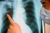 Диагноз "туберкулез" подтвердился у 1 студента техникума Батайска
