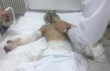 Избитой ингушской девочке ампутировали руку