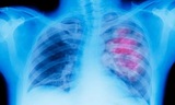 Онкологи назвали самые первые признаки опухоли легких