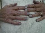 Кардиологи рассказали, как определить смертельное состояние по цвету ногтей