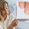 Симптомом каких заболеваний являются белые пятна на ногтях, рассказали врачи