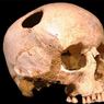 3000 лет назад в Сибири делали сложные операции на мозге