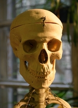 Специалисты из Новосибирска изготавливают индивидуальные 3D-заплатки для черепа