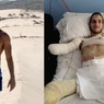 Из-за неправильного диагноза врачей итальянец лишился рук и ног