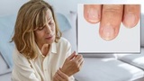Симптомом каких заболеваний являются белые пятна на ногтях, рассказали врачи